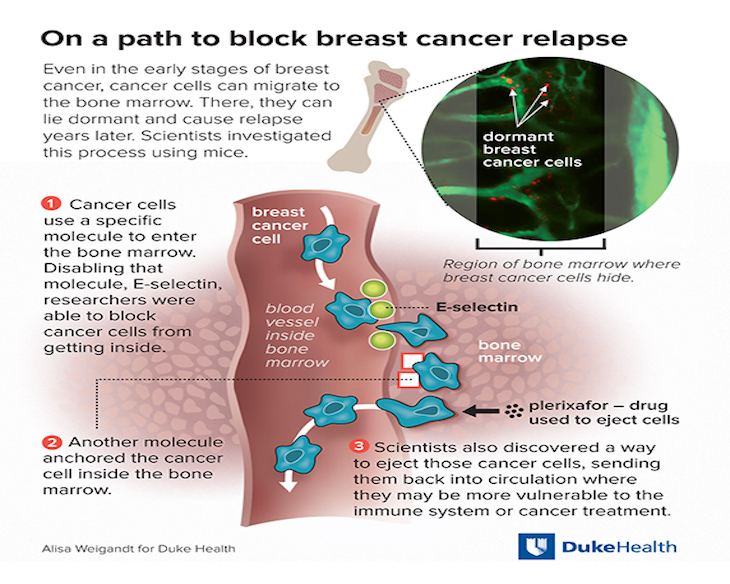 Scientists Block Breast Cancer Cells From Hiding in Bones Duke Health